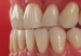 Picture of REF-LINE Upper Anterior Teeth